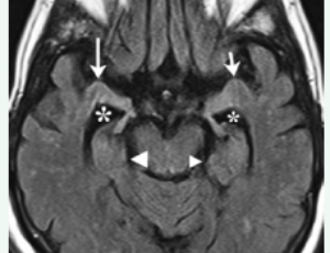 Journal of Neurology and Translational Neuroscience