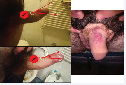 Penis before and after treatment with CCH; Ecchymosis developed and resolved in about 48 hours.