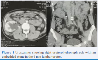 Uroscanner showing right ureterohydronephrosis with an embedded stone in the 6 mm lumbar ureter.