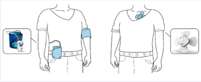 Figure 1 The blood pressure monitoring devices. Left - the currentlyused traditional cuff-based ambulatory blood pressure monitoring  device; Right - the disposable cuffless photoplethysmography-based  chest patch device.