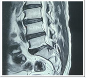 Figure 2 Sagittal MRI of L/S Spine