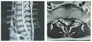 Figure 3 Axial MRI of L/S Spine with pilot film.