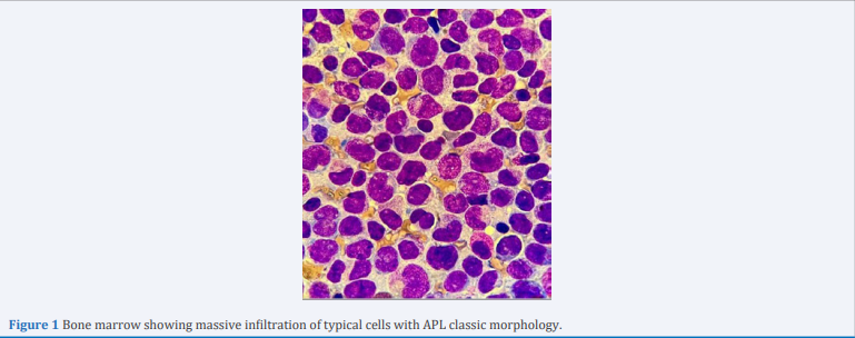 Bone marrow showing massive infiltration of typical cells with APL classic morphology.