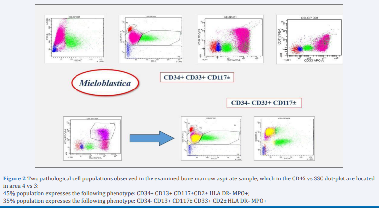 Two pathological cell populations observed in the examined bone marrow aspirate sample, which in the CD45 vs SSC dot-plot are located in area 4 vs 3: 45% population expresses the following phenotype: CD34+ CD13+ CD117±CD2± HLA DR- MPO+; 35% population expresses the following phenotype: CD34- CD13+ CD117± CD33+ CD2± HLA DR- MPO+