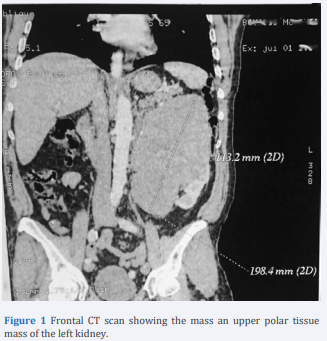 Frontal CT scan showing the mass an upper polar tissue mass of the left kidney.