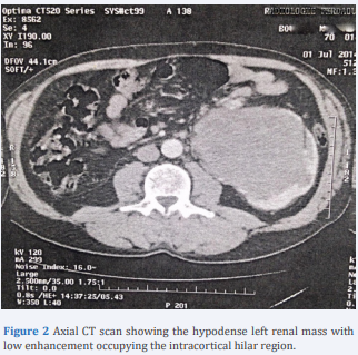 Axial CT scan showing the hypodense left renal mass with low enhancement occupying the intracortical hilar region.