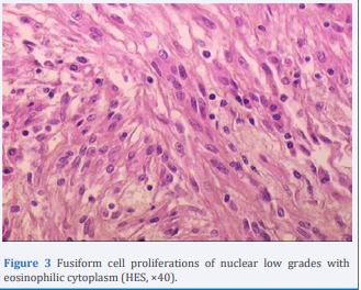 Fusiform cell proliferations of nuclear low grades with eosinophilic cytoplasm (HES, ×40).