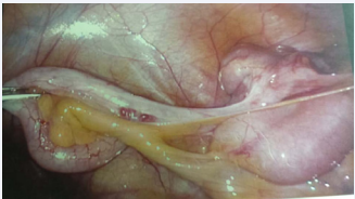 Treves ileocaecal fold at laparoscopy in a thin female patient with normal appendix.