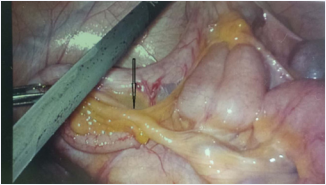 Note the inferior attachment of fold to mesoappendix. Limiting coagulation of mesoappendix up to the attachment safeguards the blood supply to base of appendix and caecal pole.