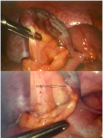 Prominent Treves fold with attachment to mesoappendix in an obese patient with complicated appendicitis. Limiting coagulation to the attachment (marked) ensures adequate blood supply to appendicular stump.