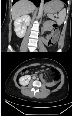 Axial view CT scan demonstrating the intestinal vasculature entering into a left sided paraduodenal hernia (A) and a coronal view of a well-defined bowel containing sac (B).