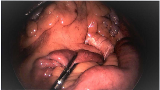 Intraoperative images of the distal bowel protruding from the fossa of Landzert (arrow).