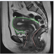 Figure 1a CA: Anterior compartment includes: B: Bladder; VU: Vesico Uterinepouch: VV: Vesico Vaginal septum; CM: Middle Compartment; U: Uterus, CP: Posterior Compartment; R: Rectum; V: Posterior vaginal fornix; RV: Recto vaginal septum; C: Retrocervical area; P: Peritoneum; RU: Recto Uterine pouch. Anatomical locations of deep pelvic endometriosis, compartments, MR T2- weighted.