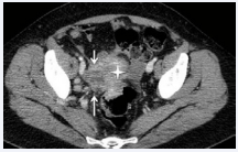 Figure 2b CT after contrast administration, pelvic imaging, parauterine sample mass [arrows] with utero-rectal and parametrial affectation, responsible for the hydronephrosis by ureteral entrapment, Uterus (Star).