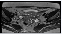 Figure 3a Irregular solid mass (defined by the line), invades uterus [U], rectum [R], it affects mesorectal fascia and includes right ovary [O]. It corresponds to an extensive affectation by deep endometriosis. In this ovarian, a small endometrioma with shading is appreciated [A] Iliac adenopaties. MR, transverse planes, a&bT2-weighted image; c&d T1-weighted image with fat suppression.