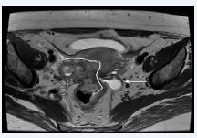 Figure 3b The mass described in (Figure 3a) [line] and left utero sacral affectation is identified with image pseudo cyst [arrow].