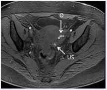 Figure 3d Endometriomas in left ovary [O, arrow] and hemorrhagic focus on left uterosacral ligament [US, arrow].