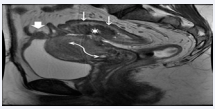 Figure 4b Rectal extra luminal mass, solid invasive endometriosis, Mushroom cap sign, represents the low signal intensity core of fibrotic endometriois and hypertrophic muscular propia [star], capped by high signal intensity mucosa [straight arrows]. It is seen in uterus a loss of definition of the joint area, with impaired myometrial signal caused by adenomyosis. Naboth cyst in cérvix [curved arrows].