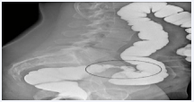 Figure 5a Lateral image from a barium examination which shows circumferential narrowing of the rectosigmoid [circle], with mass effect and spiculations of the anterior margin.