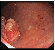 Figure 5b Colonoscopy, vegetating and polilobulated lesion located 14cm away from the anal margin. Erythematous mucosal areas are seen between 18 and 10 cm from the anal margin, with small shallow ulcers covered by fibrin.