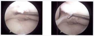 Figure 1 Arthroscopic image of the anomalous insertion of the anterior cruciate ligament on the lateral meniscus.