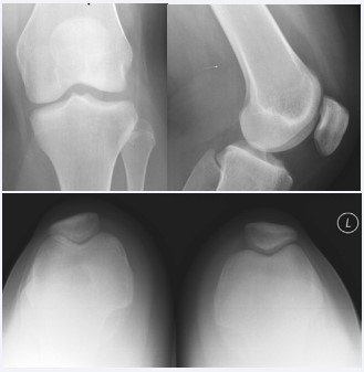 Figure 2 Anteroposterior, lateral and sunrise radiographs of the left knee revealed no abnormalities.