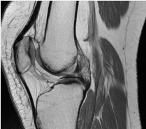 Figure 3 Sagital image from MRI.