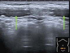 Figure 2 Rupture in both abdominal muscles.