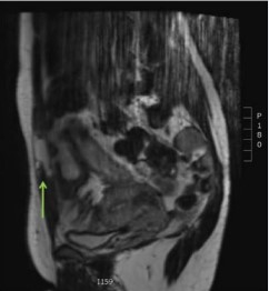 Figure 4 MRI T2, Coronal view of the right abdominal muscle.