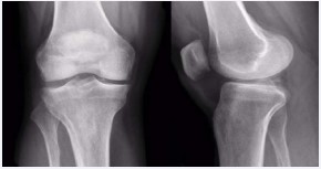 Figure 1 x-rays of the knee showing the bone body in the posterior region of the medial compartment.
