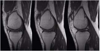 Figure 2 Sagittal MRI cuts showing the ossicle in the posterior horn of the medial meniscus.