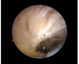 Figure 3 Arthroscopic image obtained with the optics in the anterolateral portal. The progress in the interval (p) between the fibers of the Posterior Cruciate Ligament (*) and the medial condyle (cm) confer access to the posterior region of the medial compartment..