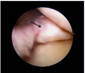 Figure 5 Arthroscopic image of the meniscal ossicle in the posterior horn of the medial meniscus (arrow).