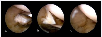 Figure 6 Sequence of images showing the removal of fragments from the posterior horn (a, b) and the final aspect of the procedure (c).
