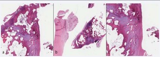 Figure 8 Histologic cuts of the meniscal fragments shows hyaline alterations and metaplastic ossification, apart from a degenerative process, fibrosis, and foci of neovascularization (hematoxylin-eosin).