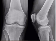 Figure 9 Post-operative x-rays of the knee showing the absence of the bone body in the posterior region of the medial compartment.