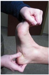 Figure 3 Tenderness over the attachment of plantar fascia on the medial aspect of the heel that is exacerbated with dorsiflexion of the great toe.