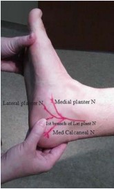 Figure 5 Digital pressure over the first branch of the lateral plantar nerve can cause pain and tingling sensation.