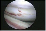 Figure 3 Arthroscopic evaluation of the joint showed a chondral fracture and dent in the lateral femoral condyle.