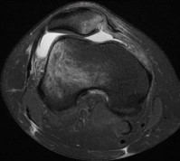 Figure 2 MRI scan showing lateralisation of the patella after patella dislocation.