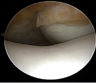 Figure 4 Patella lateralisation from an arthroscopic view.