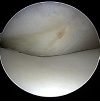 Figure 5 Arthroscopic view after femoral fixation of the MPFL.