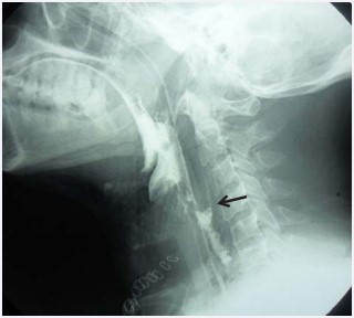 Figure 2 Gastrographin swallow. Showing loss of cervical lordosis denoting neck muscles spasm, widening of the prevertebral space due to edema and surgical emphysema. Ba leak into the retropharyngeal space (arrow) is noted at the level of upper border of C4.