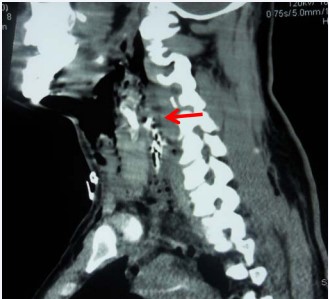 Figure 3 CT scan neck with gastrographin swallow Sagittal cut. Showing loss of cervical lordosis denoting neck muscles spasm, widening of the prevertebral space due to edema and surgical emphysema. Ba leak into the retropharyngeal space (arrow) is noted at the level of upper border of C4.