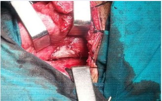 Figure 4 Free non-vascularized fascia lata flap sutured to the posterior pharyngeal wall covering the whole pharyngeal tear