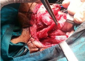 Figure 5 Superiorly pedicled vascularized sternomastoid muscle (SCM) flap(arrow) prepared to be sutured near the fascia lata graft