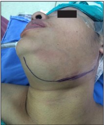 Figure 1 Conventional skin incision.