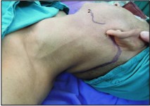 Figure 2 Retroauricular skin incision (1), marking of angle of mandible (2).