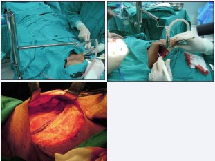 Figure 3 Working space beneath elevated subplatysmal flap by Chung’s retractor.