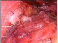 Figure 4 Identification of marginal mandibular branch of facial nerve around angle of mandible(1). Posterior belly digastric muscle (2).